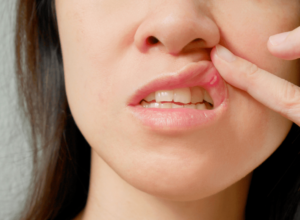 Mouth Ulcers Treatment