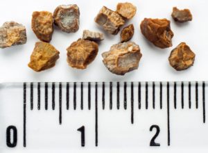 Kidney Stone Natural Treatment